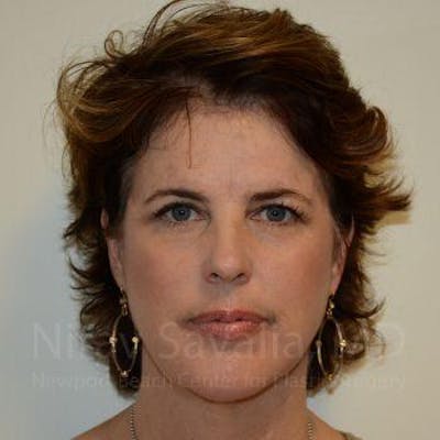 Case--1655688 | After Fat Grafting To Face