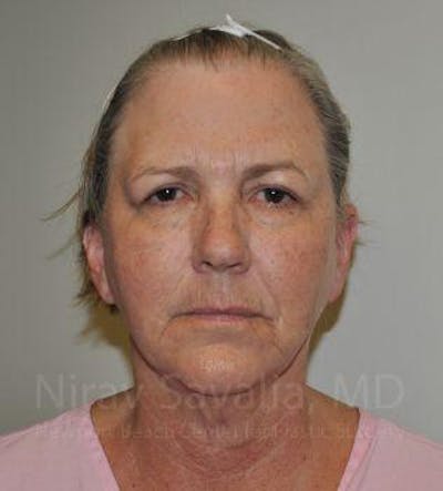 Case--1655705 | Before Fat Grafting To Face