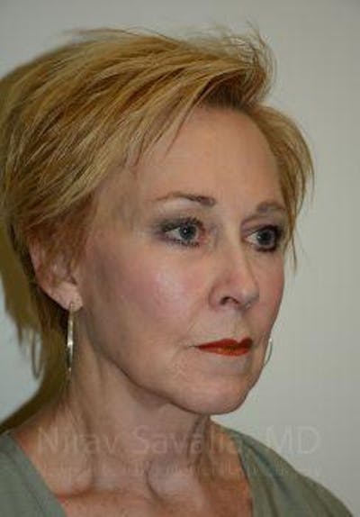 Case--1655725 | After Fat Grafting To Face