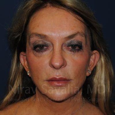Case--1655730 | Before Fat Grafting To Face
