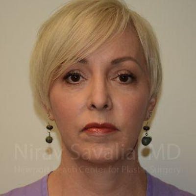 Case--1655787 | After Fat Grafting To Face