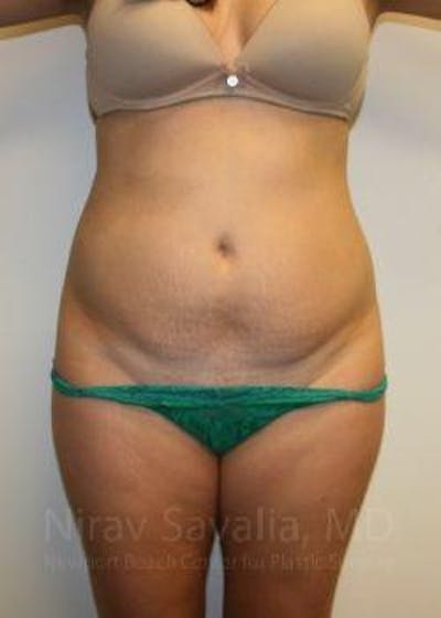 Case--1655599 | Before Liposuction