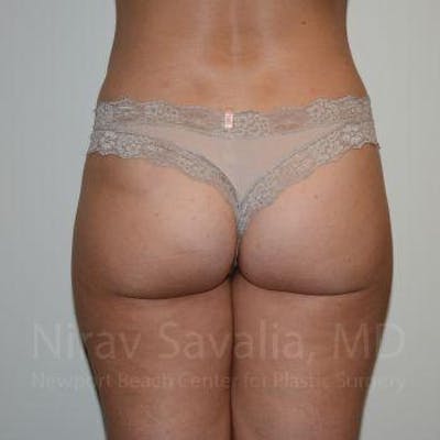Case--1655622 | After Liposuction