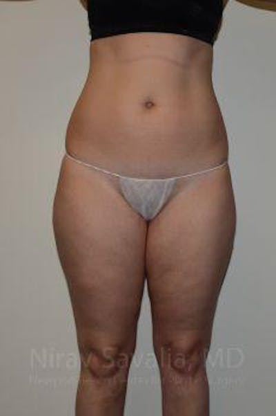 Case--1655629 | Before Liposuction