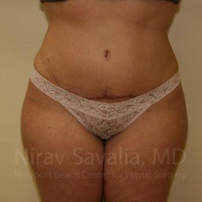 Case--1655647 | After Liposuction