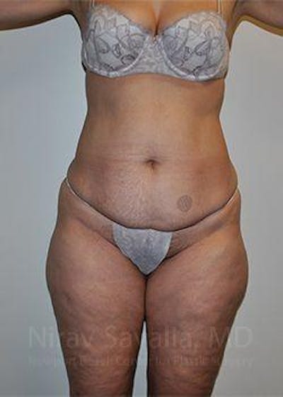 Case--1655654 | Before Liposuction