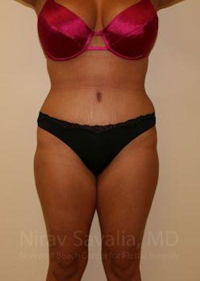 Case--1655656 | After Liposuction