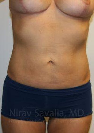 Case--1655658 | After Liposuction