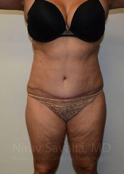 Case--1655664 | After Liposuction