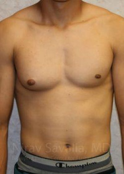 Case--1655607 | Before Male Breast Reduction