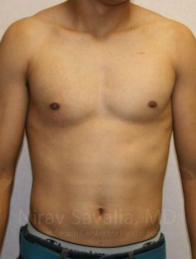 Case--1655607 | After Male Breast Reduction