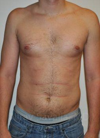 Case--1655612 | Before Male Breast Reduction