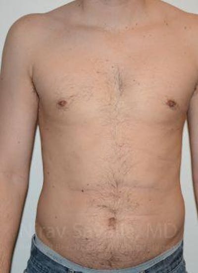 Case--1655612 | After Male Breast Reduction