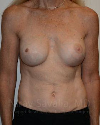 Case--1655466 | After Mastectomy Reconstruction Revision