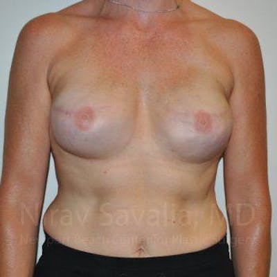 Case--1655474 | After Mastectomy Reconstruction