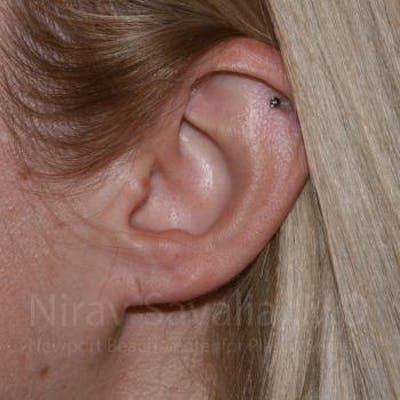 Case--1655679 | Before Torn Earlobe Repair Ear Gauge Repair