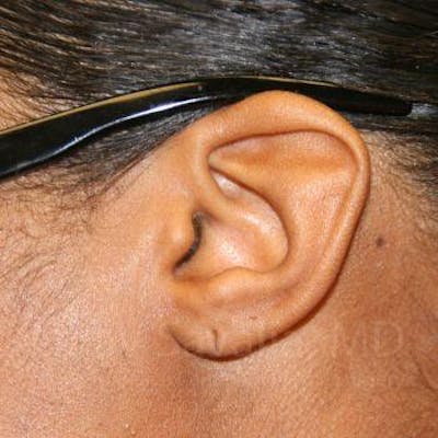 Case--1655684 | Before Torn Earlobe Repair Ear Gauge Repair