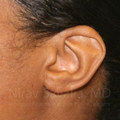 Case--1655684 | After Torn Earlobe Repair Ear Gauge Repair