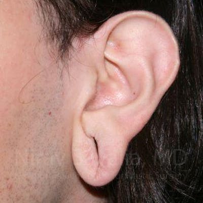 Case--1655686 | Before Torn Earlobe Repair Ear Gauge Repair