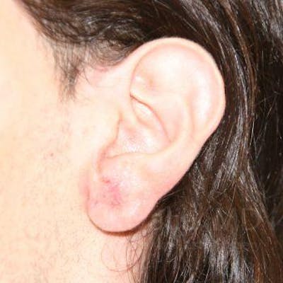 Case--1655686 | After Torn Earlobe Repair Ear Gauge Repair