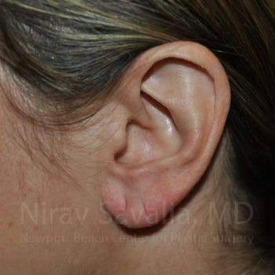 Case--1655691 | Before Torn Earlobe Repair Ear Gauge Repair
