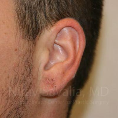 Case--1655692 | After Torn Earlobe Repair Ear Gauge Repair