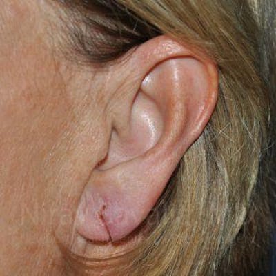 Case--1655697 | Before Torn Earlobe Repair Ear Gauge Repair