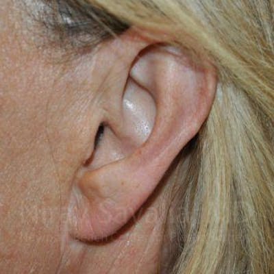 Case--1655697 | After Torn Earlobe Repair Ear Gauge Repair