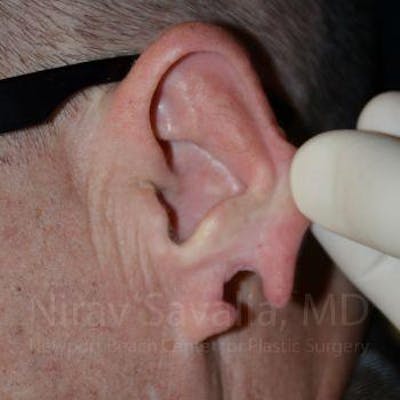Case--1655700 | Before Torn Earlobe Repair Ear Gauge Repair
