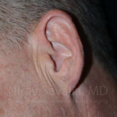 Case--1655700 | After Torn Earlobe Repair Ear Gauge Repair
