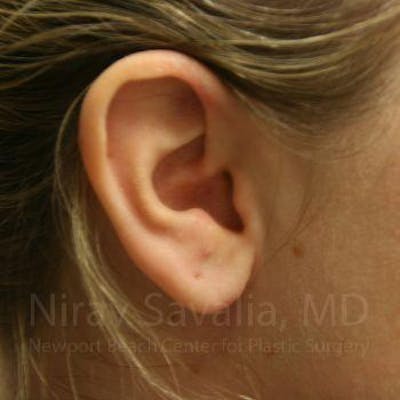 Case--1655703 | After Torn Earlobe Repair Ear Gauge Repair