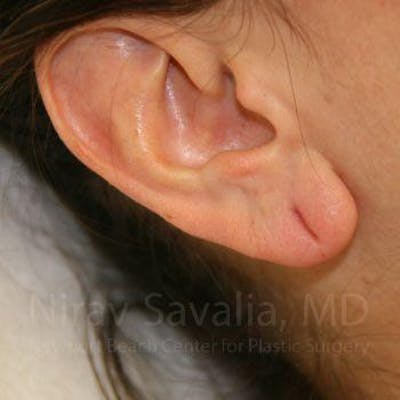 Case--1655708 | Before Torn Earlobe Repair Ear Gauge Repair