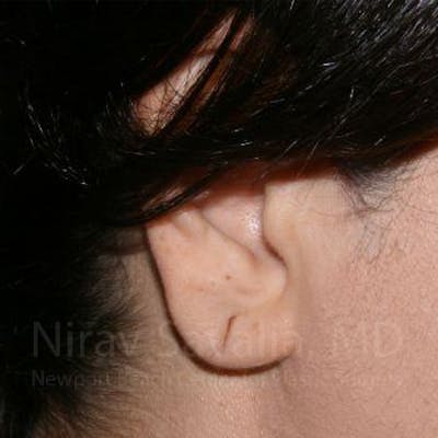 Case--1655709 | Before Torn Earlobe Repair Ear Gauge Repair
