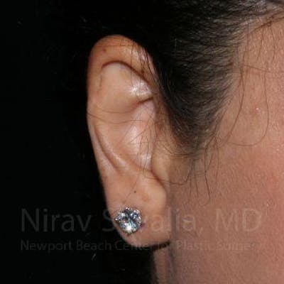 Case--1655709 | After Torn Earlobe Repair Ear Gauge Repair
