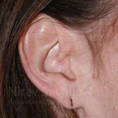 Case--1655713 | Before Torn Earlobe Repair Ear Gauge Repair