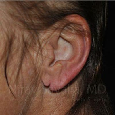 Case--1655715 | Before Torn Earlobe Repair Ear Gauge Repair