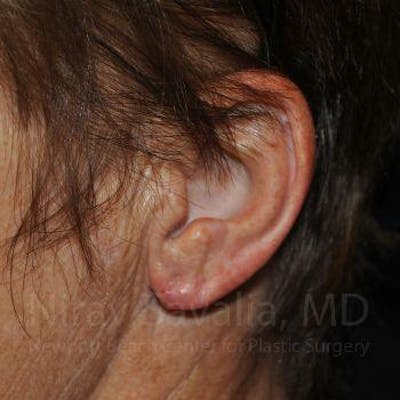 Case--1655715 | After Torn Earlobe Repair Ear Gauge Repair