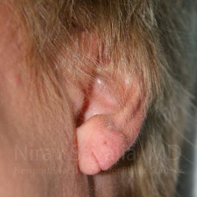 Case--1655718 | Before Torn Earlobe Repair Ear Gauge Repair
