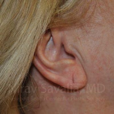 Case--1655722 | Before Torn Earlobe Repair Ear Gauge Repair