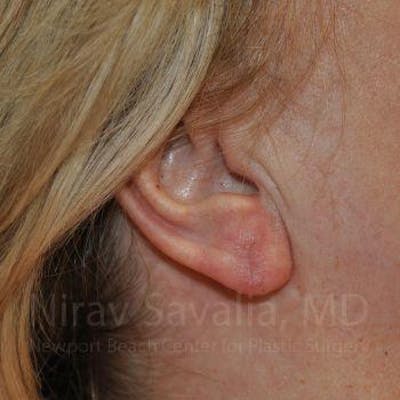 Case--1655722 | After Torn Earlobe Repair Ear Gauge Repair