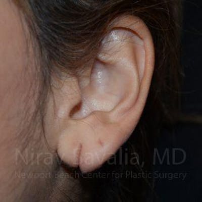 Case--1655729 | Before Torn Earlobe Repair Ear Gauge Repair