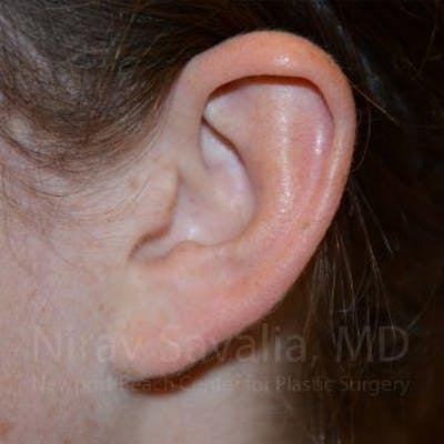 Case--1655729 | After Torn Earlobe Repair Ear Gauge Repair