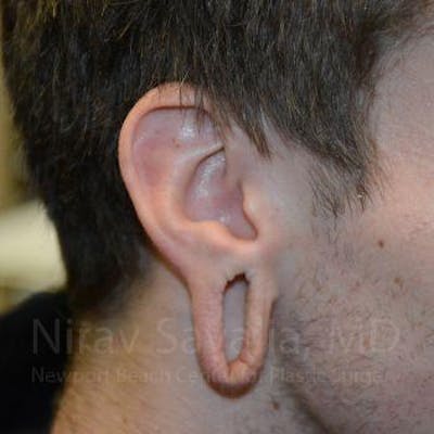 Case--1655788 | Before Torn Earlobe Repair Ear Gauge Repair