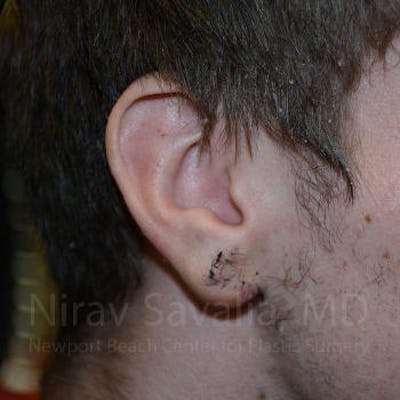 Case--1655788 | After Torn Earlobe Repair Ear Gauge Repair