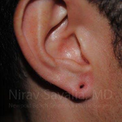 Case--1655790 | Before Torn Earlobe Repair Ear Gauge Repair