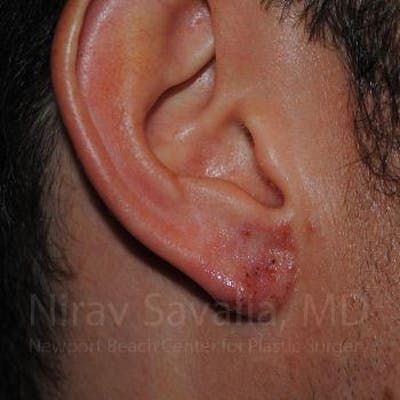Case--1655790 | After Torn Earlobe Repair Ear Gauge Repair