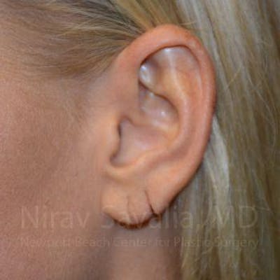 Case--1655792 | Before Torn Earlobe Repair Ear Gauge Repair