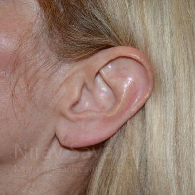 Case--1655794 | Before Torn Earlobe Repair Ear Gauge Repair