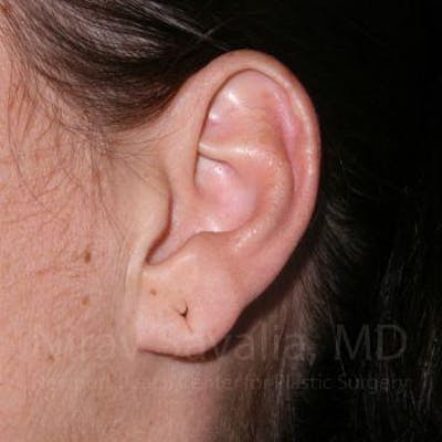 Case--1655797 | Before Torn Earlobe Repair Ear Gauge Repair
