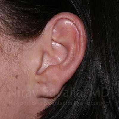 Case--1655797 | After Torn Earlobe Repair Ear Gauge Repair